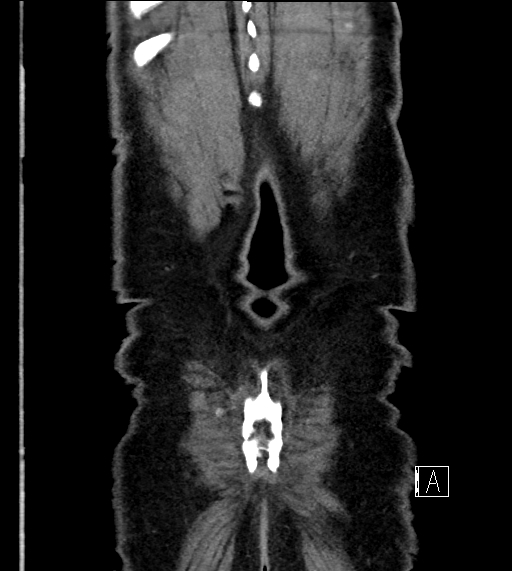 Adrenal lymphoma (Radiopaedia 73730-84529 Coronal C+ portal venous phase 78).jpg