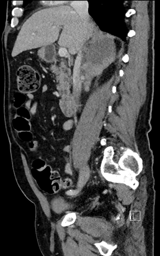 Adrenal lymphoma (Radiopaedia 73730-84529 Sagittal C+ portal venous phase 47).jpg