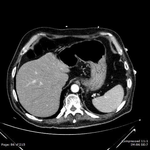 Adrenal metastasis (Radiopaedia 78425-91079 Axial C+ arterial phase 16).jpg