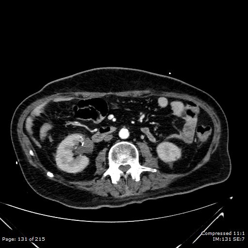 Adrenal metastasis (Radiopaedia 78425-91079 Axial C+ arterial phase 61).jpg