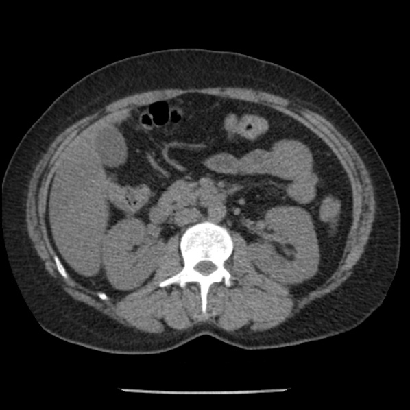 File:Adrenal myelolipoma (Radiopaedia 43401-46759 Axial non-contrast 37).jpg