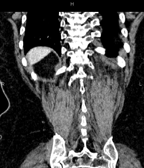 File:Adrenal myelolipoma (Radiopaedia 82742-96986 Coronal renal cortical phase 65).jpg