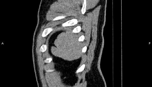 Adrenal myelolipoma (Radiopaedia 84321-99619 Sagittal non-contrast 103).jpg