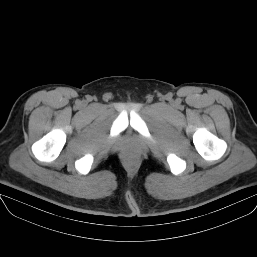 File:Adrenal myelolipoma - bilateral (Radiopaedia 74805-85810 Axial non-contrast 88).jpg