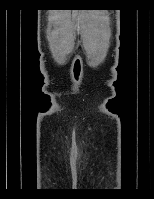 Adrenal myelolipoma - bilateral (Radiopaedia 74805-85810 Coronal C+ portal venous phase 37).jpg