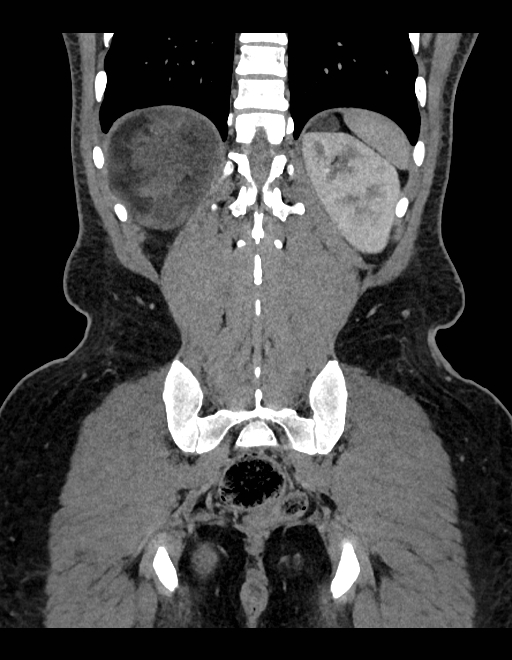 Adrenal myelolipoma - bilateral (Radiopaedia 74805-85810 Coronal C+ portal venous phase 84).jpg