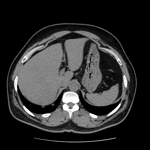 Adrenal myelolipoma and beaver tail liver (Radiopaedia 86201-102193 Axial non-contrast 93).jpg