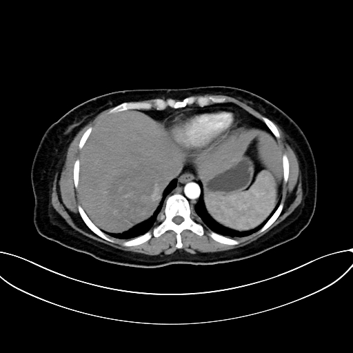 Adrenocortical carcinoma (Radiopaedia 87281-103569 Axial C+ arterial phase 14).jpg