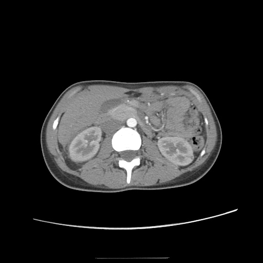 Adult polycystic kidney disease (Radiopaedia 48845-53876 Axial renal cortical phase 28).jpg
