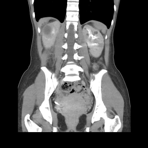 File:Adult polycystic kidney disease (Radiopaedia 48845-53876 Coronal renal excretory phase 30).jpg