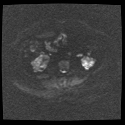 Adult polycystic kidney disease (Radiopaedia 59075-66365 Axial DWI 38).jpg