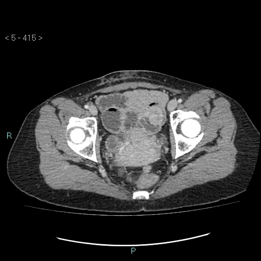 Adult transient intestinal intussusception (Radiopaedia 34853-36310 Axial C+ portal venous phase 108).jpg