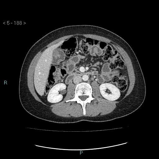 Adult transient intestinal intussusception (Radiopaedia 34853-36310 Axial C+ portal venous phase 31).jpg