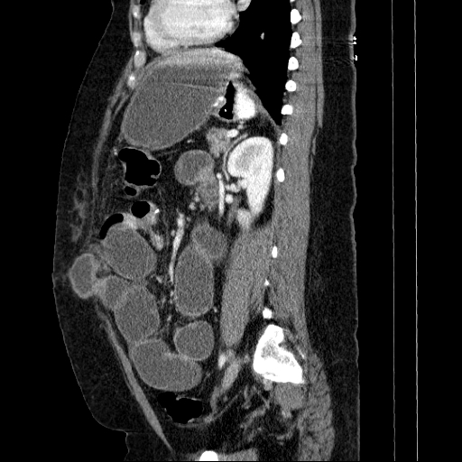 File:Afferent loop syndrome - secondary to incarcerated trocar site hernia (Radiopaedia 82959-97305 Sagittal C+ portal venous phase 58).jpg