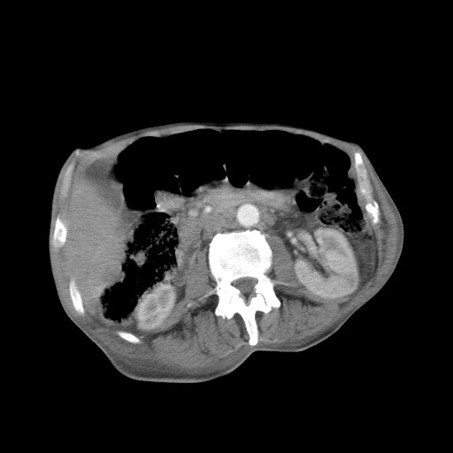 Aggressive lung cancer with cardiac metastases, pulmonary artery tumor thrombus, and Budd-Chiari (Radiopaedia 60320-67981 A 68).jpg