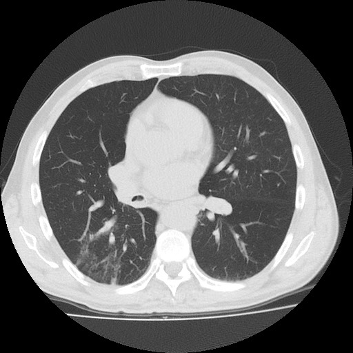 File:Allergic bronchopulmonary aspergillosis (ABPA) (Radiopaedia 60594-68313 Axial lung window 32).jpg