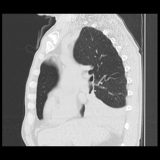 Allergic bronchopulmonary aspergillosis (ABPA) (Radiopaedia 60594-68313 Sagittal lung window 36).jpg