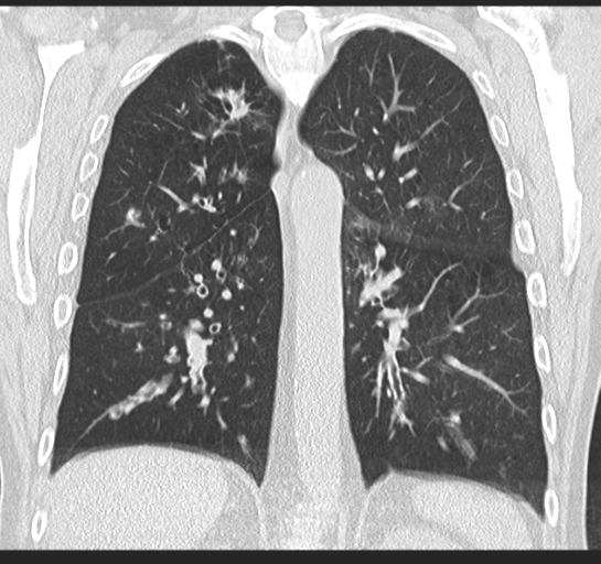 Allergic bronchopulmonary aspergillosis (Radiopaedia 44760-48571 Coronal lung window 38).png