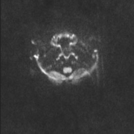 Alobar holoprosencephaly (Radiopaedia 52472-58384 Axial DWI and ADC 22).jpg