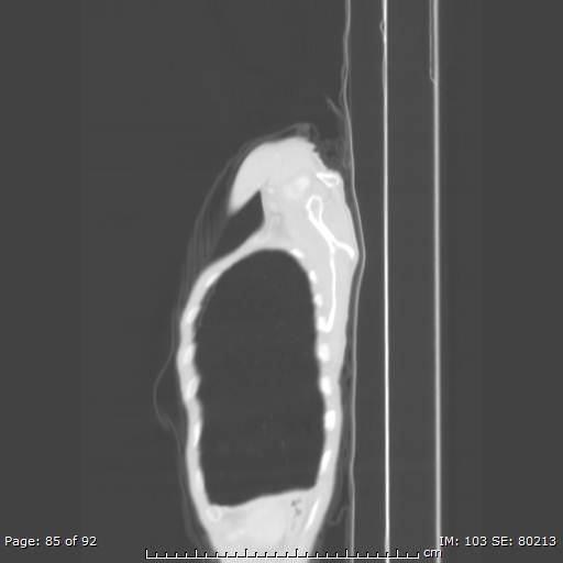 File:Alpha-1-antitrypsin deficiency (Radiopaedia 50561-55987 Sagittal lung window 41).jpg