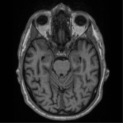 Alzheimer's disease- with Gerstmann syndrome and dressing apraxia (Radiopaedia 54882-61150 Axial T1 26).png