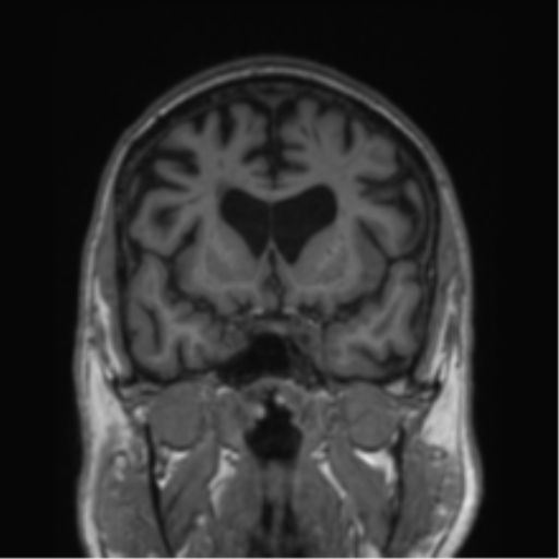 Alzheimer's disease- with Gerstmann syndrome and dressing apraxia (Radiopaedia 54882-61150 Coronal T1 58).png
