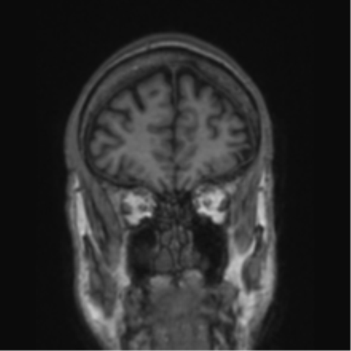 File:Alzheimer's disease- with apraxia (Radiopaedia 54763-61011 Coronal T1 74).png