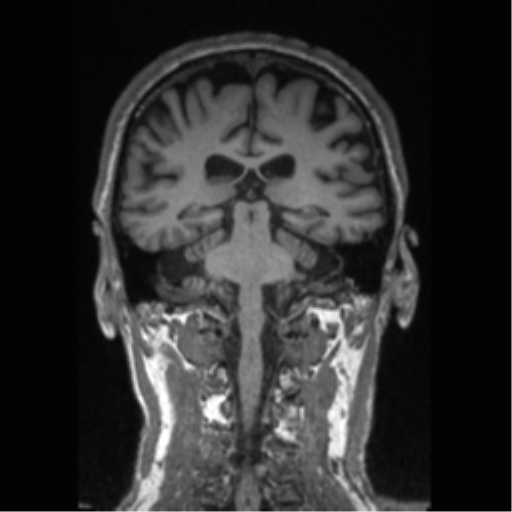 Alzheimer disease - probable (Radiopaedia 35334-36837 Coronal T1 37).png