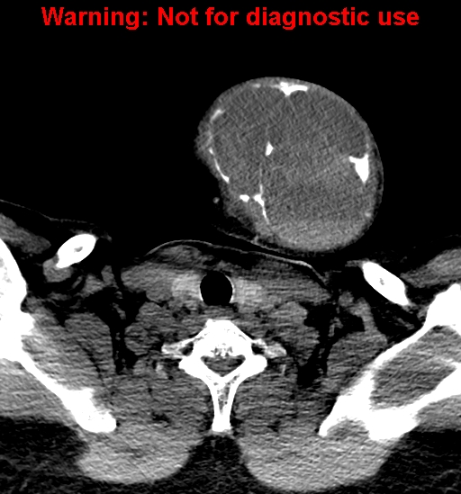 File:Ameloblastoma (Radiopaedia 33126-34164 A 34).jpg