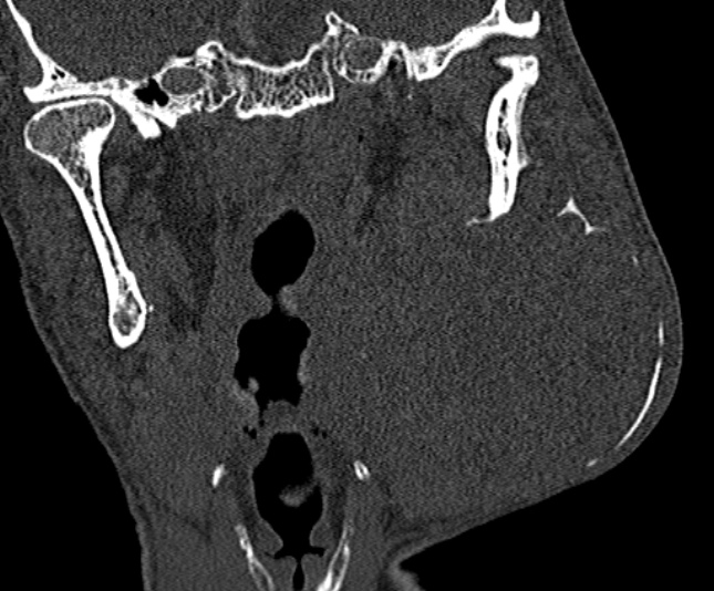 Ameloblastoma (Radiopaedia 51921-57766 Coronal bone window 174).jpg