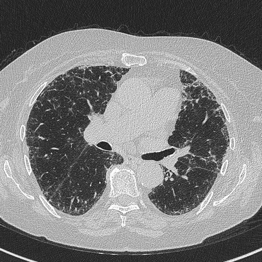 File:Amiodarone-induced pulmonary fibrosis (Radiopaedia 82355-96460 Axial lung window 33).jpg