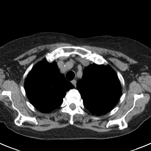 File:Amiodarone-induced pulmonary fibrosis (Radiopaedia 82355-96460 Axial non-contrast 16).jpg
