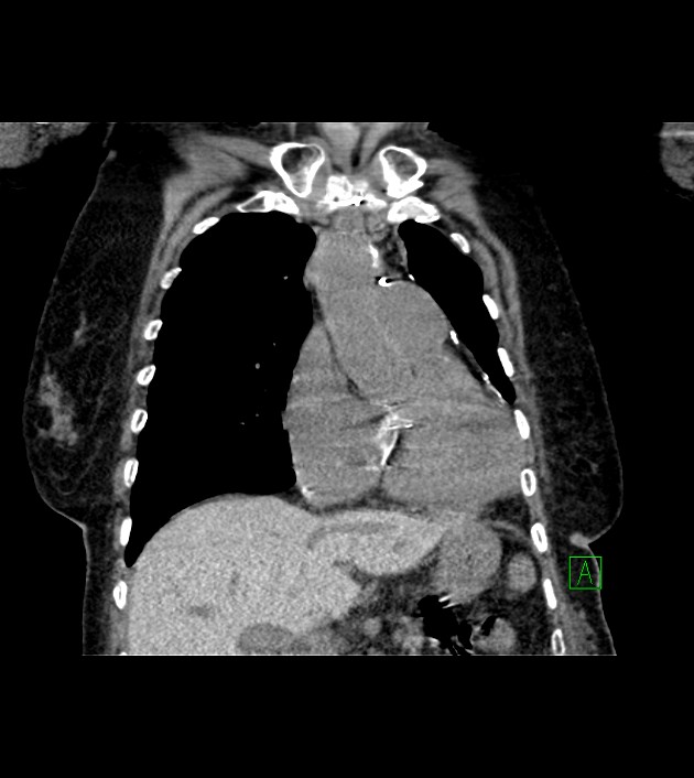 Amiodarone deposition in the liver (Radiopaedia 77587-89780 Coronal non-contrast 30).jpg