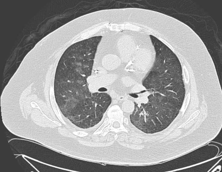 Amiodarone lung (Radiopaedia 62514-70769 Axial lung window 42).jpg