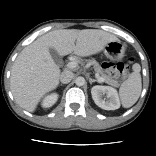 Amoebic liver abscesses (Radiopaedia 55536-62009 A 30).jpg