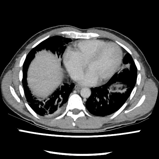 File:Amoebic liver abscesses (Radiopaedia 55536-62010 A 7).jpg