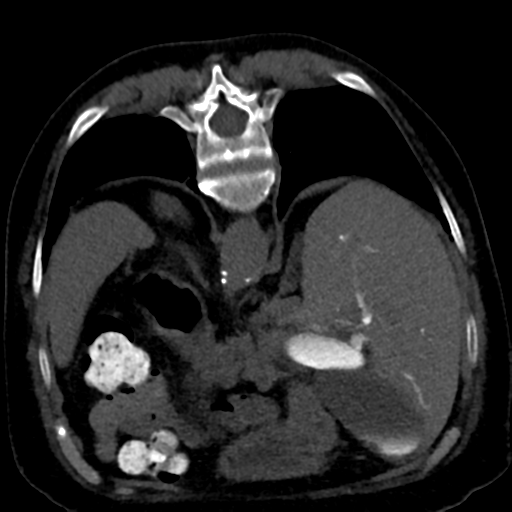 Ampullary adenocarcinoma (Radiopaedia 34013-35241 C 31).png