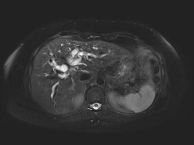 Ampullary adenocarcinoma (Radiopaedia 54765-61014 Axial T2 space-FS 19).jpg