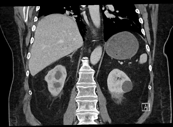 Ampullary adenocarcinoma (Radiopaedia 59373-66737 B 50).jpg