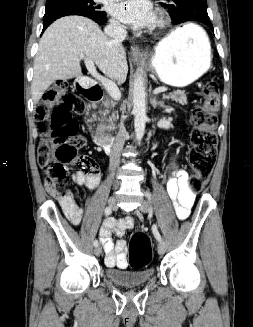 Ampullary adenocarcinoma (Radiopaedia 86093-102032 C 34).jpg