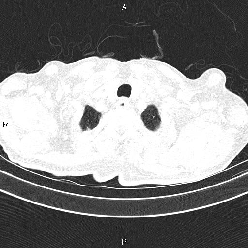 Ampullary adenocarcinoma (Radiopaedia 86093-102033 Axial lung window 13).jpg