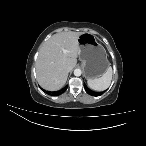 Ampullary tumor (Radiopaedia 60333-67998 A 12).jpg