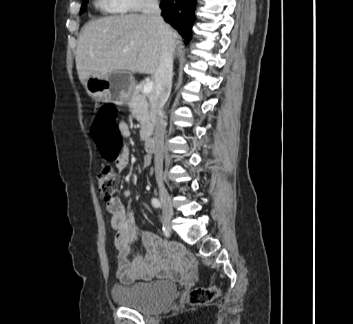 File:Ampullary tumor (Radiopaedia 60333-67998 C 25).jpg