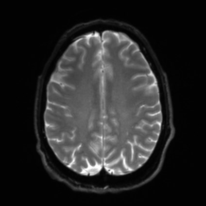 File:Amyotrophic lateral sclerosis (Radiopaedia 87352-103658 Axial DWI 20).jpg