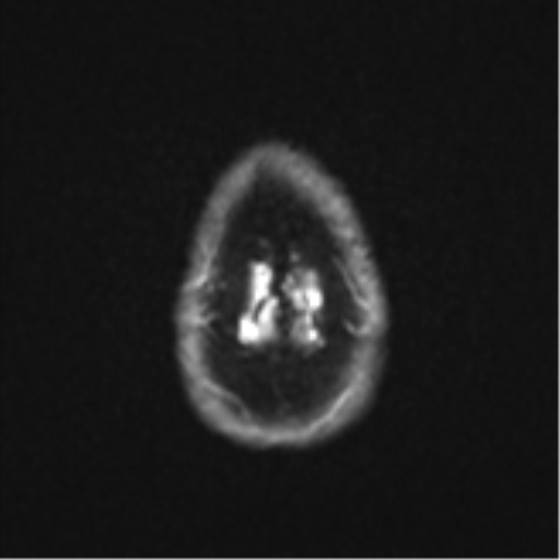Anaplastic astrocytoma (Radiopaedia 57768-64731 Axial DWI 28).png