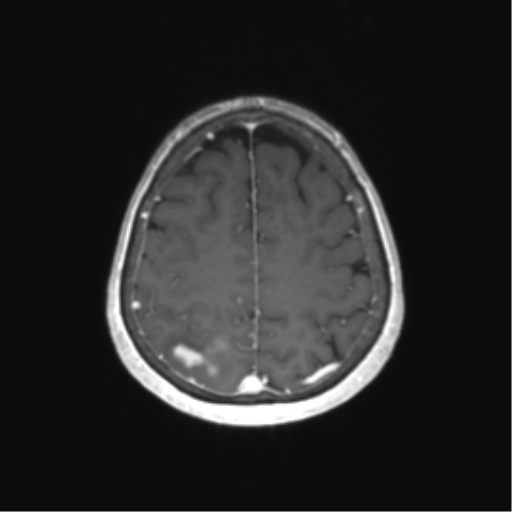 File:Anaplastic astrocytoma (Radiopaedia 86943-103160 Axial T1 C+ 66).png