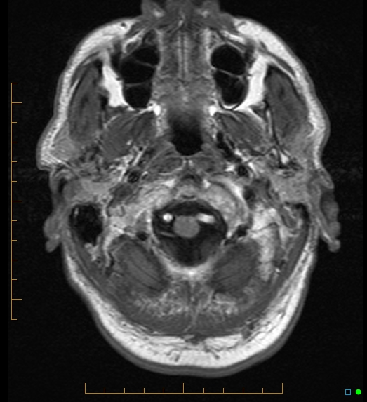 File:Anaplastic astrocytoma (WHO grade III) of the septum pellucidum (Radiopaedia 39365-41633 Axial T1 2).jpg