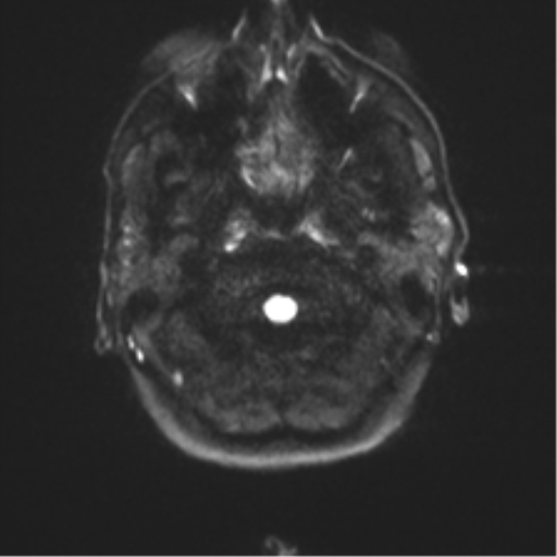 Anaplastic astrocytoma - thalamic glioma (Radiopaedia 59709-67115 Axial DWI 36).png
