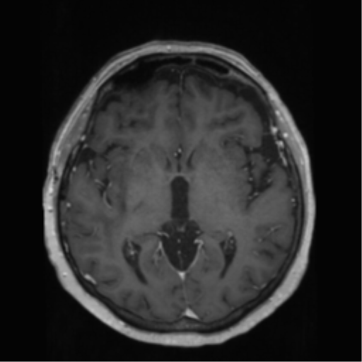 File:Anaplastic astrocytoma IDH wild-type (pseudoprogression) (Radiopaedia 42209-45278 Axial T1 C+ 79).png