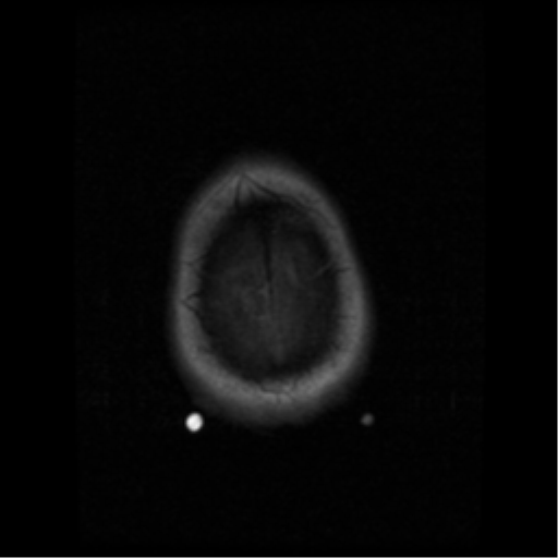 File:Anaplastic meningioma with recurrence (Radiopaedia 34452-35783 Axial T1 21).png
